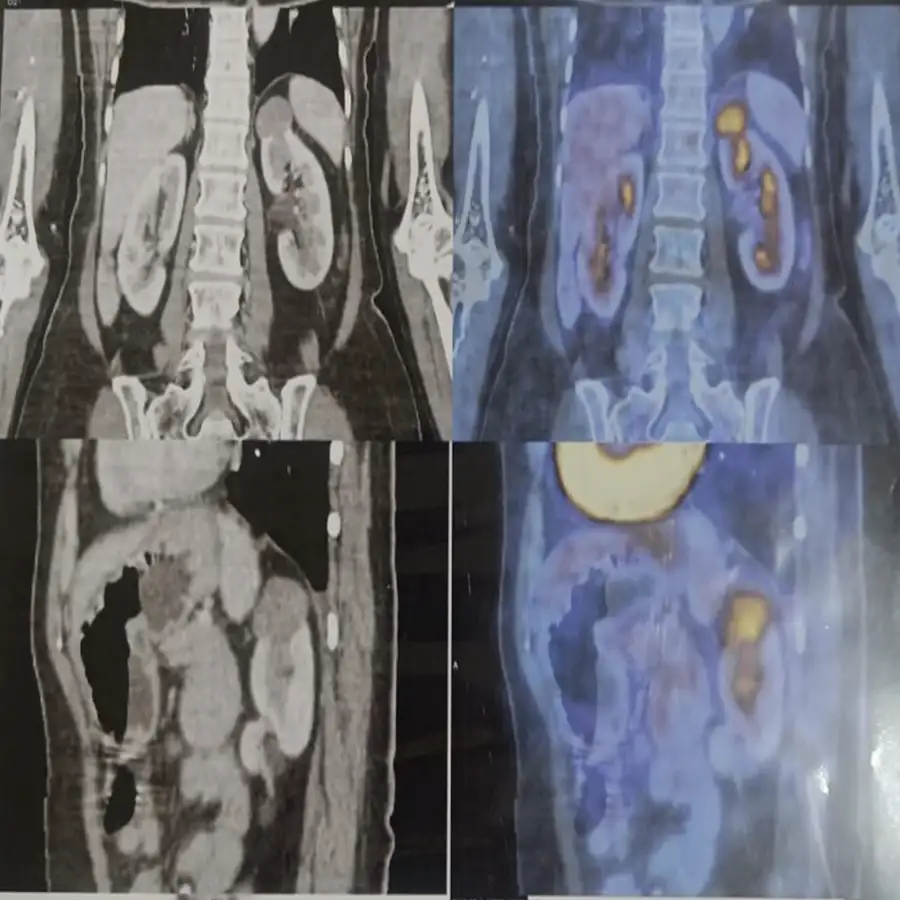 Robotic Left Partial Nephrectomy for Papillary Renal Cell Carcinoma 4