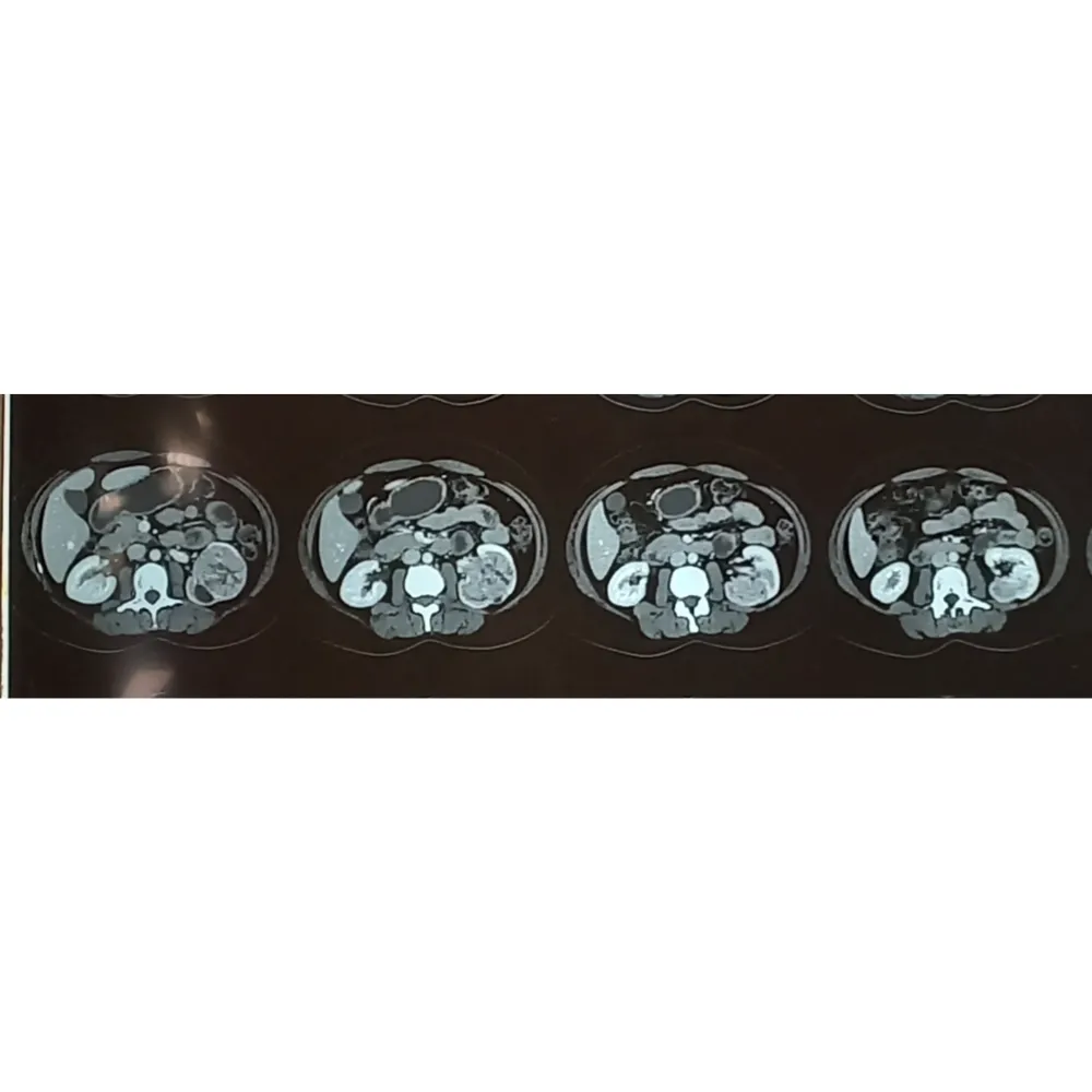 Robotic Left Radical Nephrectomy With Lymph Node Dissection For Complex Clear Cell Carcinoma 4