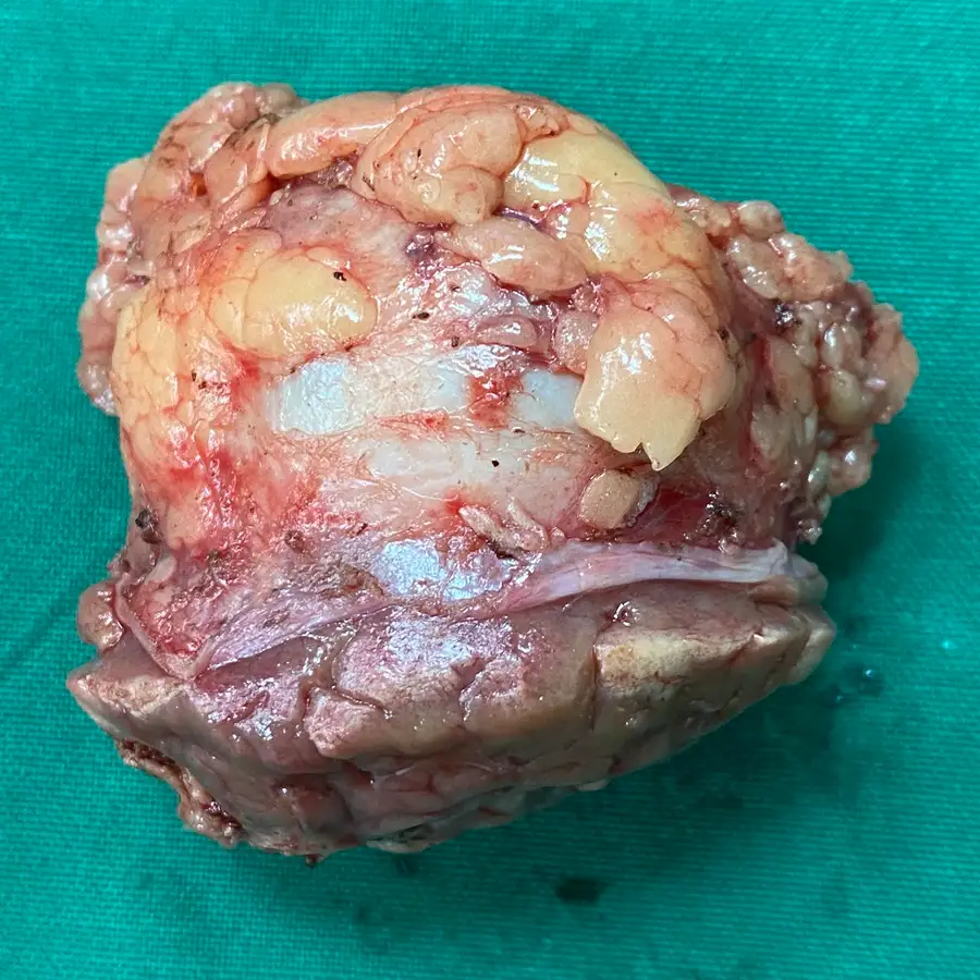 Robotic Partial Nephrectomy for Early Stage Renal Cell Carcinoma 4
