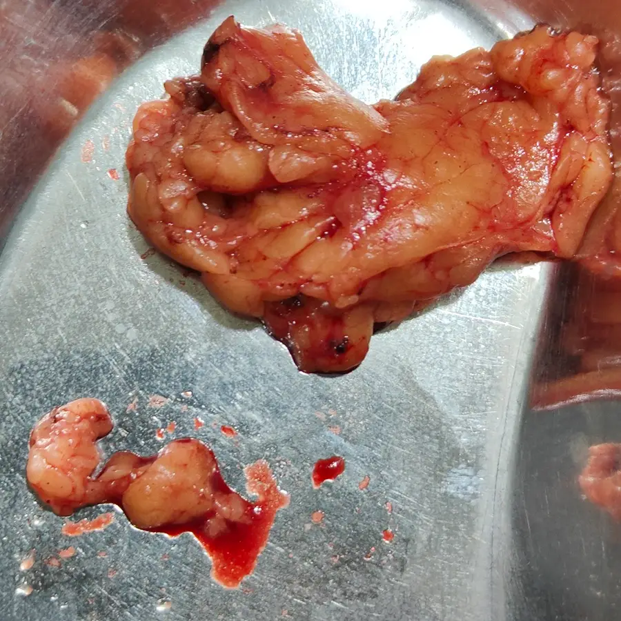 Robotic Partial Nephrectomy for T1a Renal Cell Carcinoma 4
