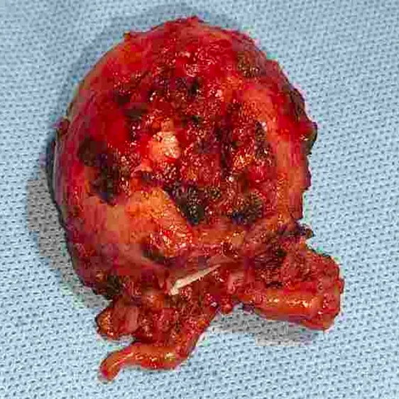 Robotic Prostatectomy for Localized Prostate Cancer with Early Recovery and Continence Preservation – Real Case 4