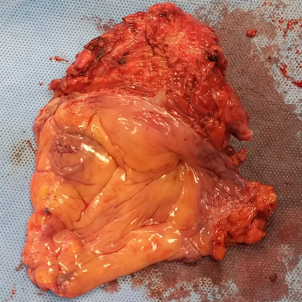 Robotic Radical Cystectomy With Ileal Conduit For High Grade Urothelial Carcinoma 1