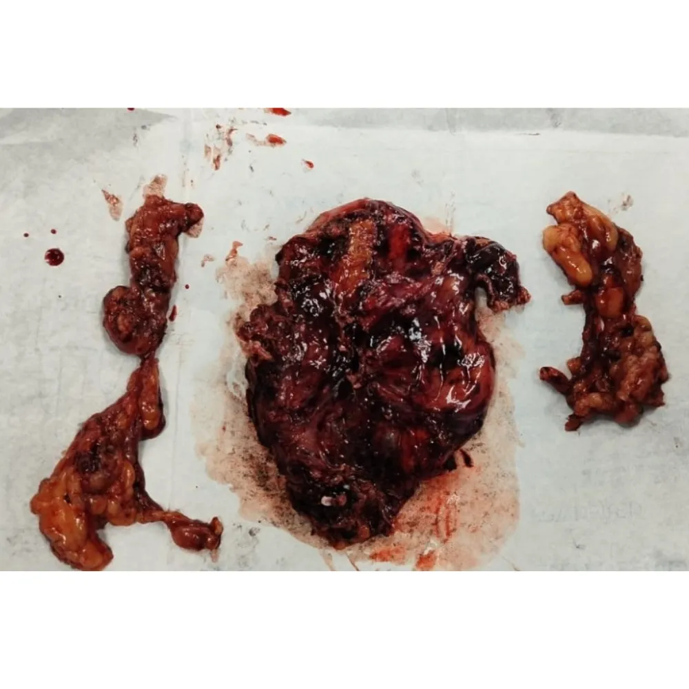 Robotic Radical Cystectomy and Neobladder Reconstruction for Muscle Invasive Bladder Cancer 1