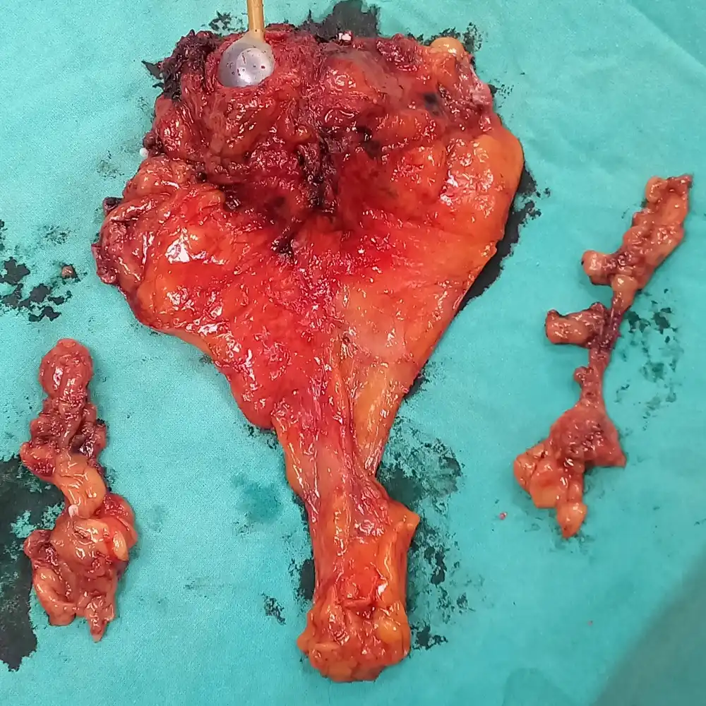 Robotic Radical Cystectomy with Hysterectomy and Neobladder Reconstruction for High Grade Urothelial Carcinoma 1