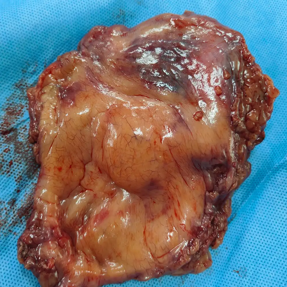 Robotic Radical Cysto Prostatectomy and Neobladder Reconstruction for High Grade Urothelial Carcinoma 1
