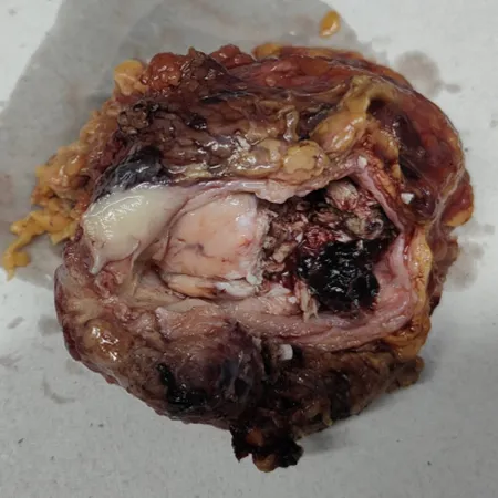 Robotic Radical Cystoprostatectomy With Neobladder Reconstruction For Bladder Cancer 1