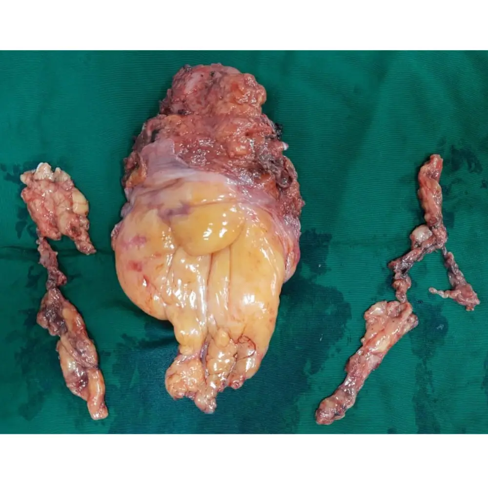 Robotic Radical Cystoprostatectomy and Ileal Conduit Urostomy for Muscle Invasive Bladder Cancer 1