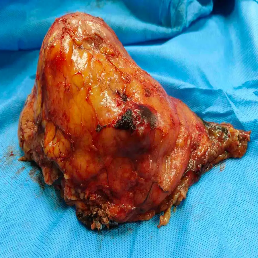 Robotic Radical Nephrectomy And Right Adrenalectomy For Advanced Clear Cell Renal Carcinoma 5