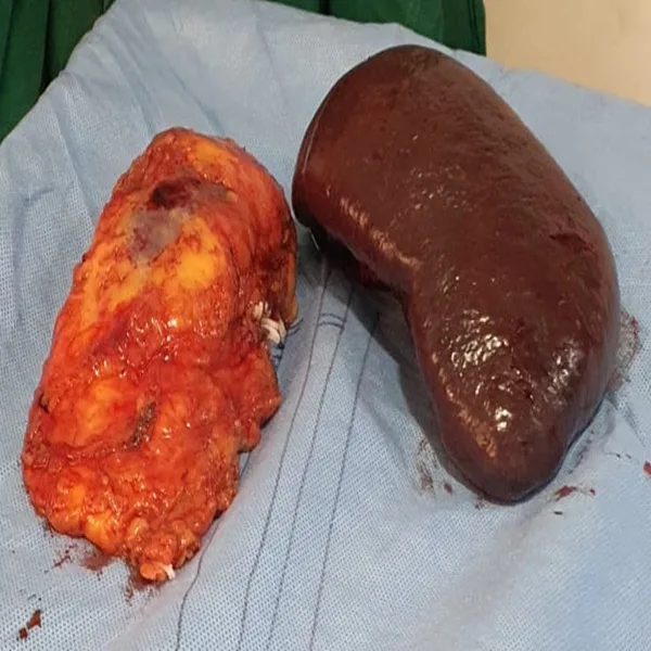 Robotic Radical Nephrectomy and Splenectomy for Recurrent Renal Cell Carcinoma 4