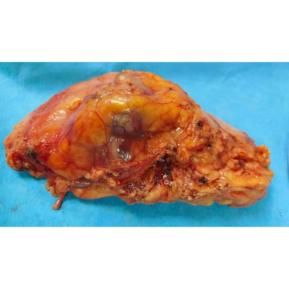 Robotic Radical Nephroureterectomy for Papillary Clear Cell Renal Cell Carcinoma 4