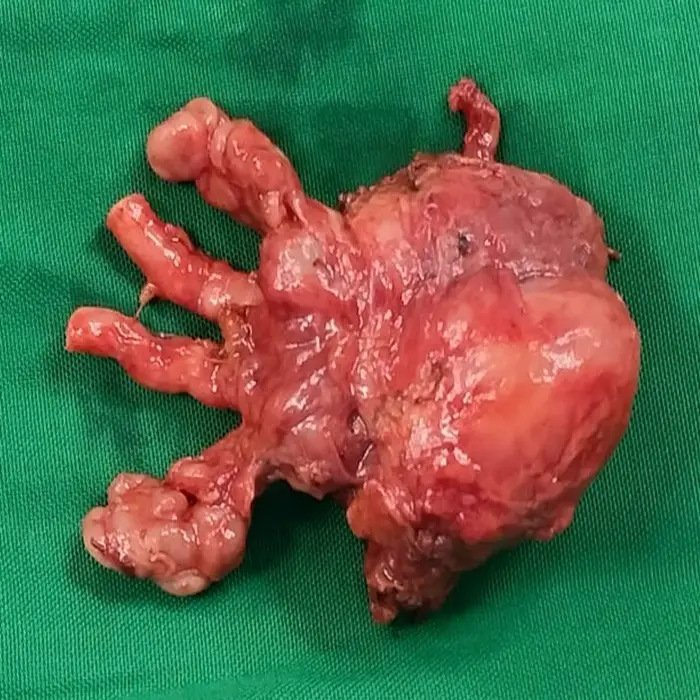 Robotic Radical Prostatectomy and Bilateral Pelvic Lymph Node Dissection for Prostatic Acinar Adenocarcinoma 4