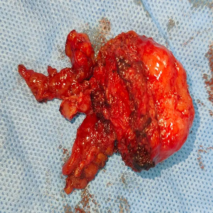 Robotic Radical Prostatectomy and RPLND for Locally Advanced Prostate Cancer