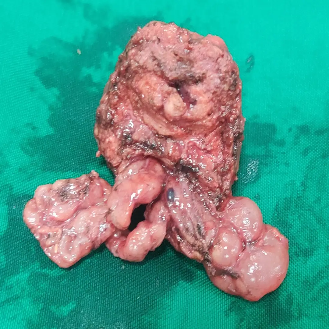 Robotic Radical Prostatectomy for Acinar Adenocarcinoma with Bilateral Lymph Node Dissection 4