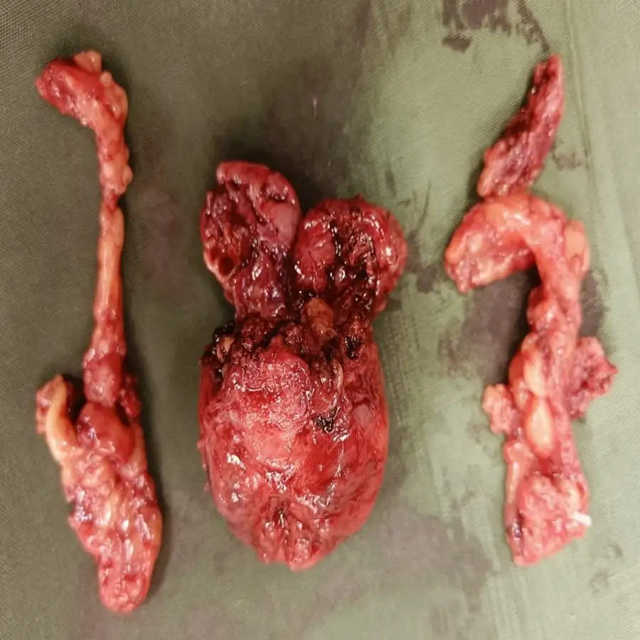 Robotic Radical Prostatectomy for Advanced Prostate Cancer pT3b with Negative Margins and Early Recovery – Real Case 4