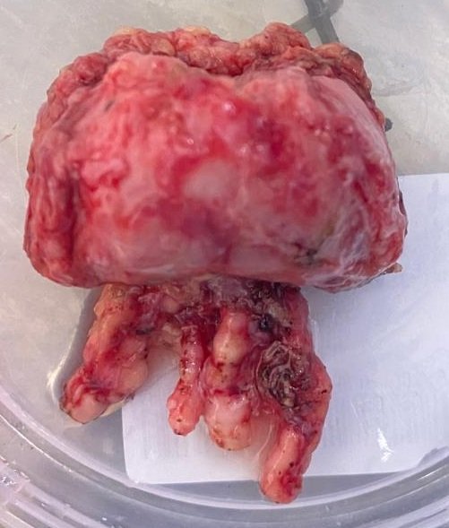 Robotic Radical Prostatectomy for Early Stage Localized Prostate Cancer in Ahmedabad 4