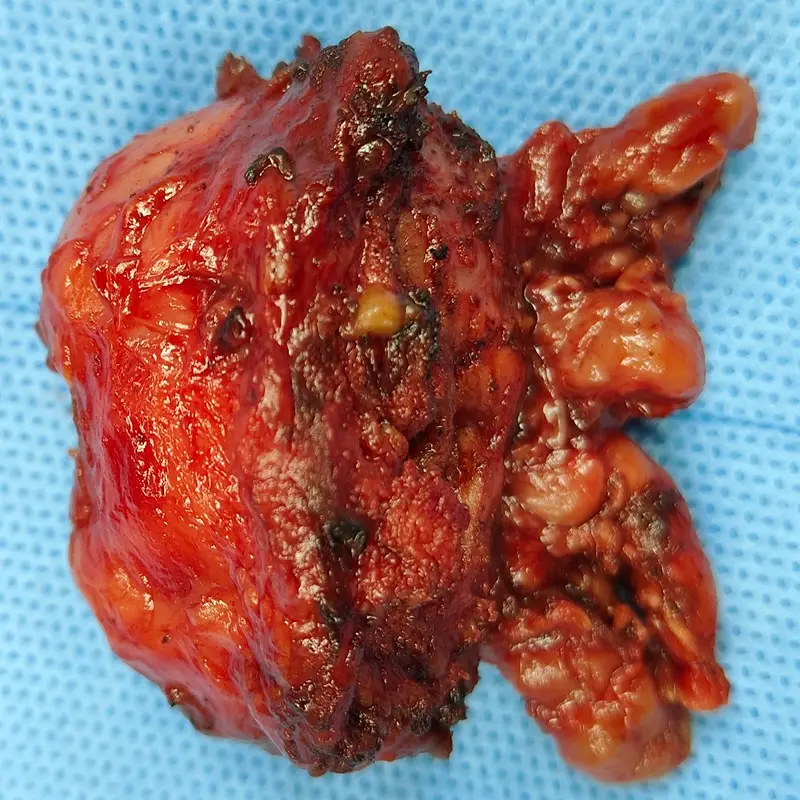 Robotic Radical Prostatectomy for High Grade Localized Prostate Cancer 4