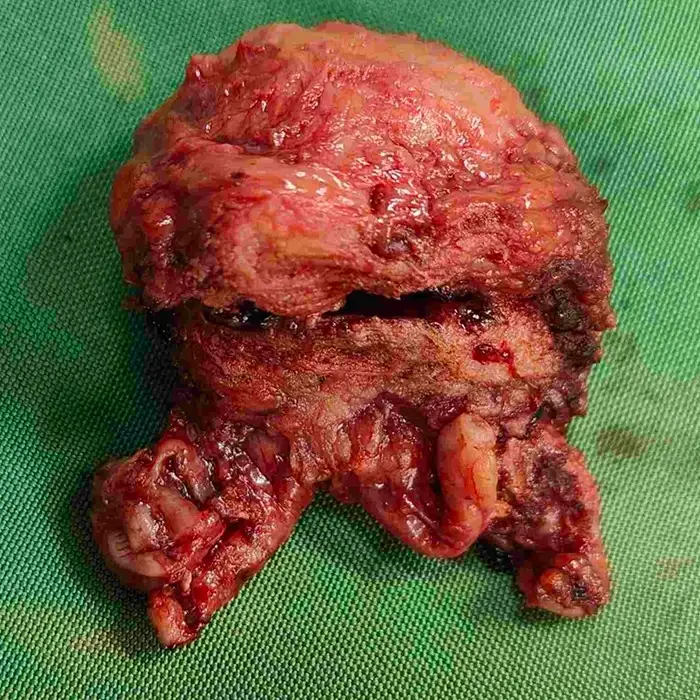 Robotic Radical Prostatectomy for High Grade Locally Advanced Prostate Cancer 4