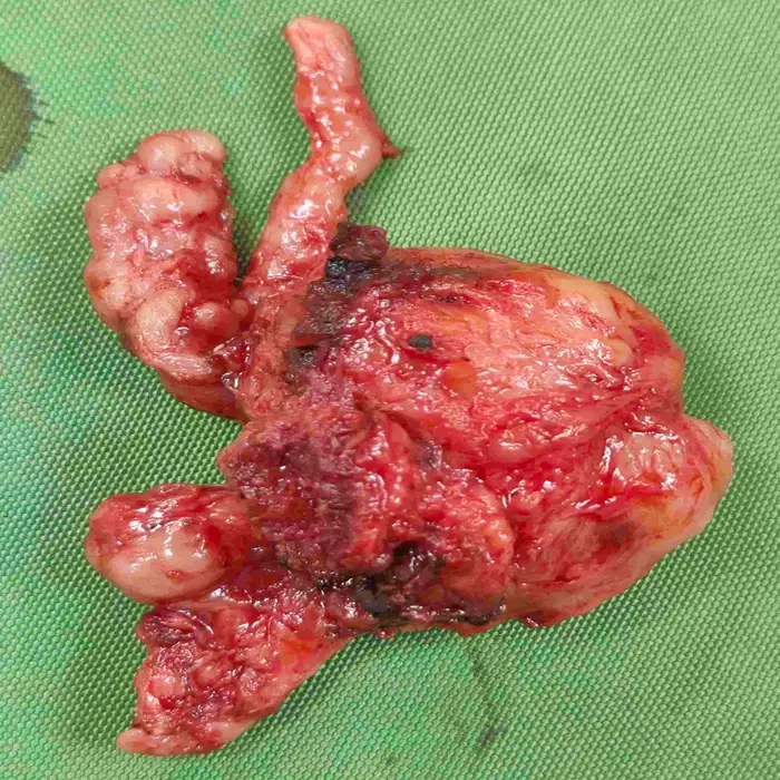 Robotic Radical Prostatectomy for High Grade Prostate Cancer in an Elderly Patient 4