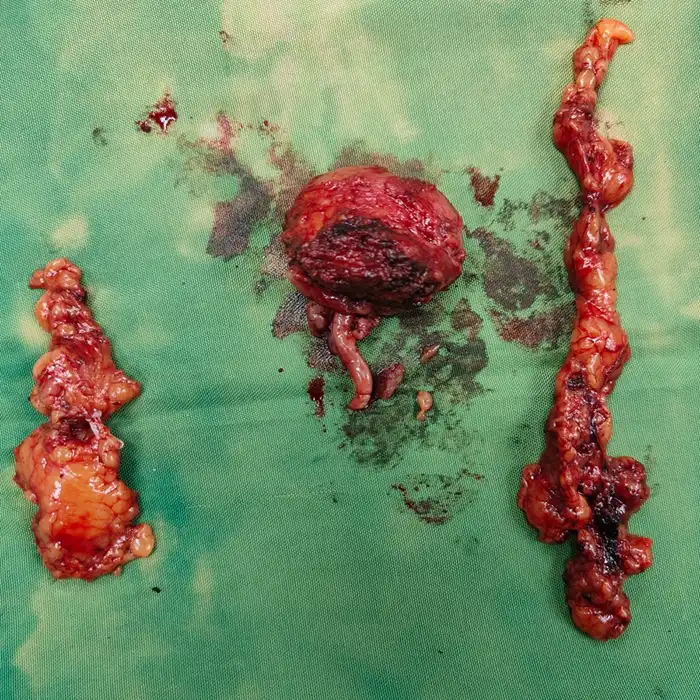 Robotic Radical Prostatectomy for High-Grade Prostate Cancer