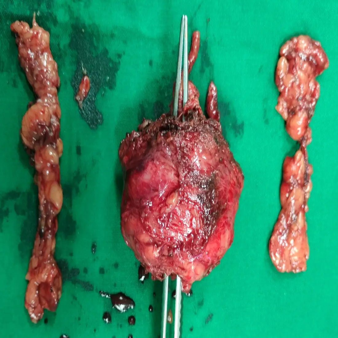 Robotic Radical Prostatectomy for High Risk Grade Group 5 Prostate Cancer 4