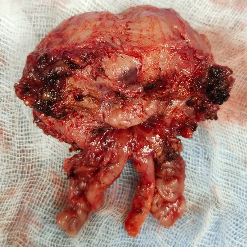 Robotic Radical Prostatectomy for Intermediate Risk Localized Prostate Cancer 4