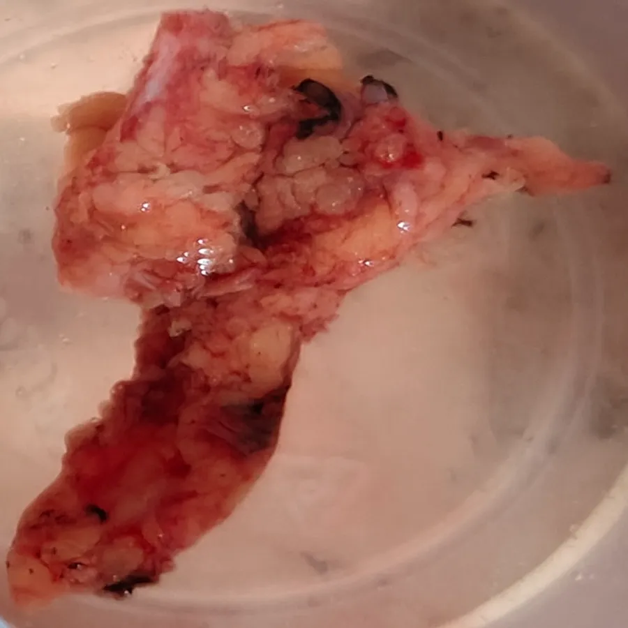 Robotic Radical Prostatectomy for Intermediate Risk Prostate Cancer 4