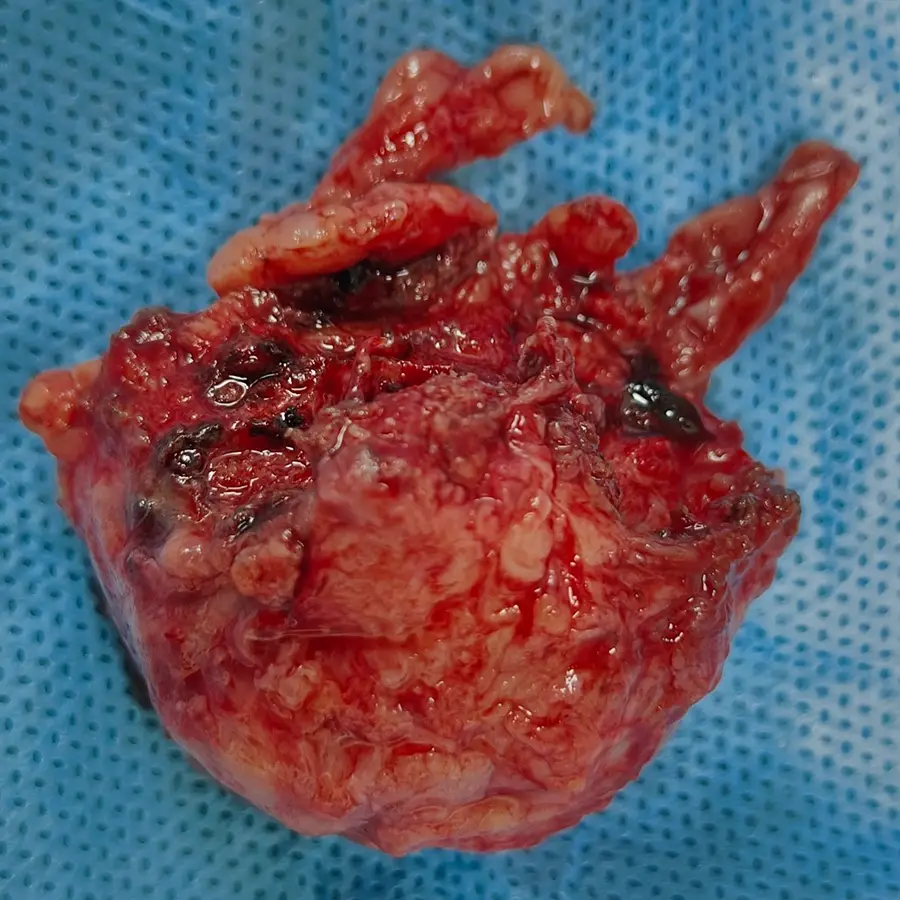 Robotic Radical Prostatectomy for Locally Advanced Prostate Cancer in an 80 Year Old Patient 4