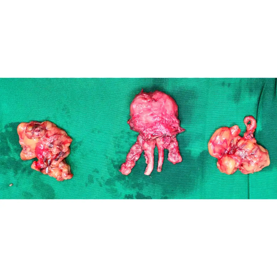 Robotic Radical Prostatectomy for Locally Advanced Prostatic Acinar Adenocarcinoma 4