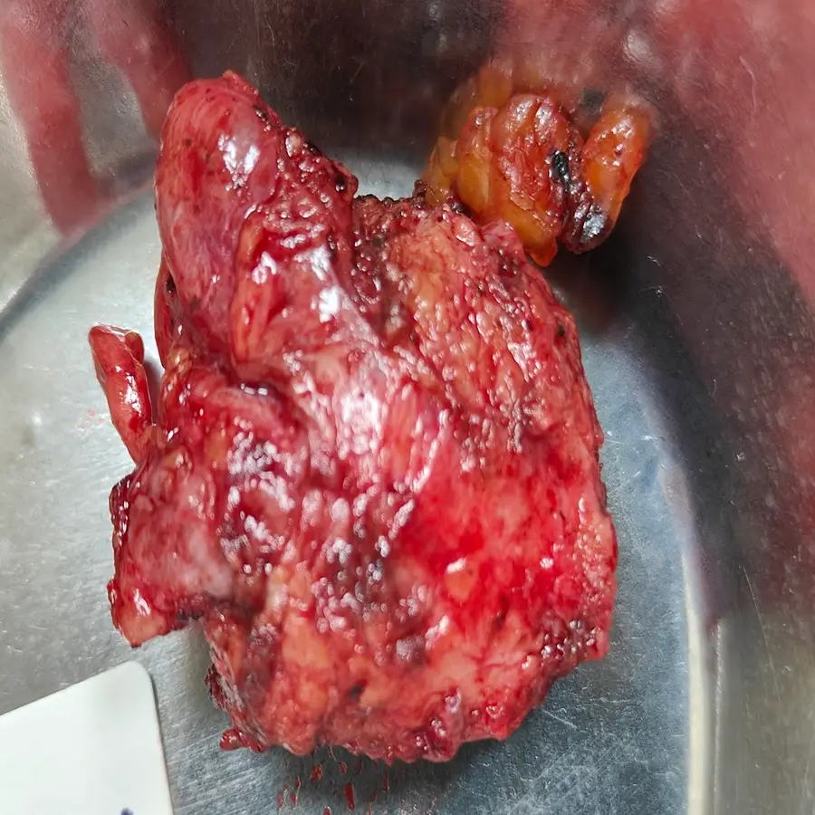 Robotic Radical Prostatectomy for Locally Advanced Stage pT3b Prostate Cancer 4