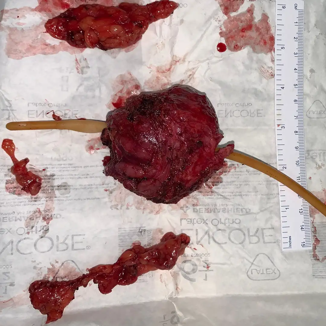 Robotic Radical Prostatectomy for Prostate Cancer with Negative Margins and Early Recovery – Real Patient Case 1