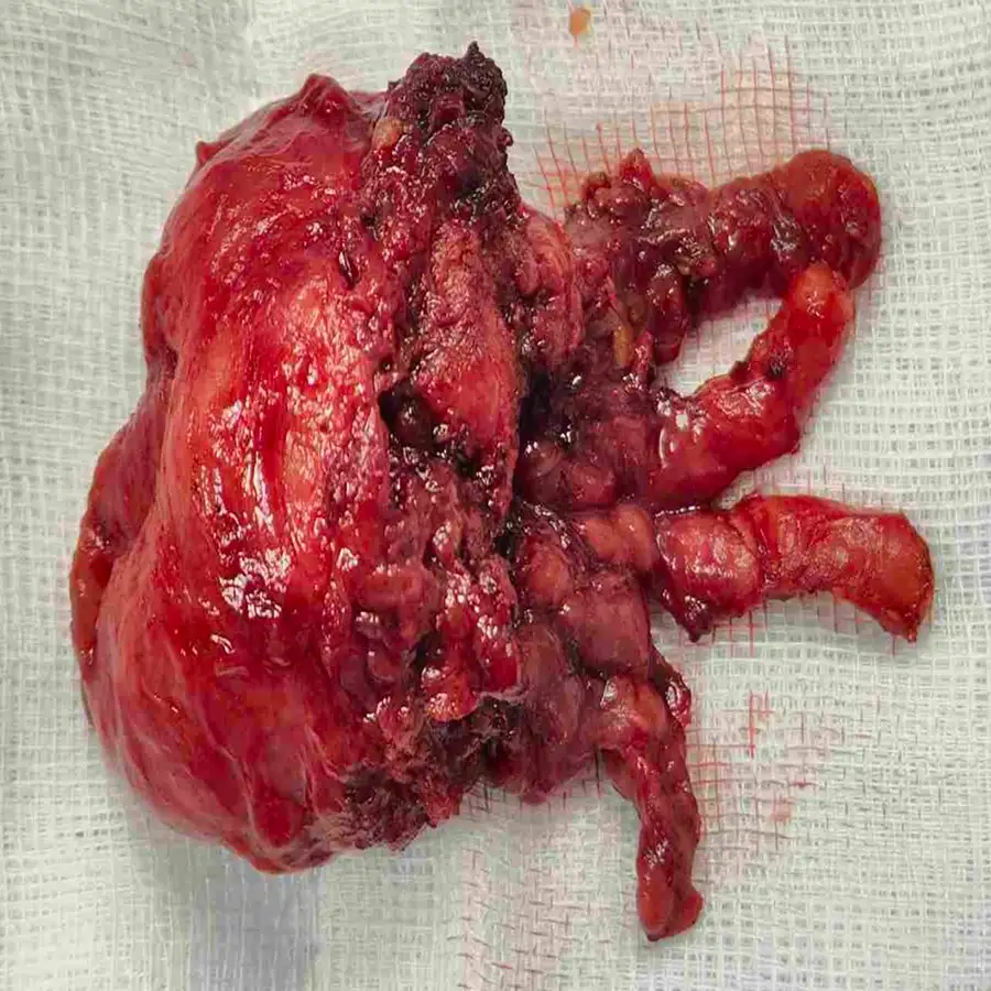 Robotic Radical Prostatectomy for Prostate Cancer with Negative Margins and Excellent Functional Outcome – Real Patient Case 4