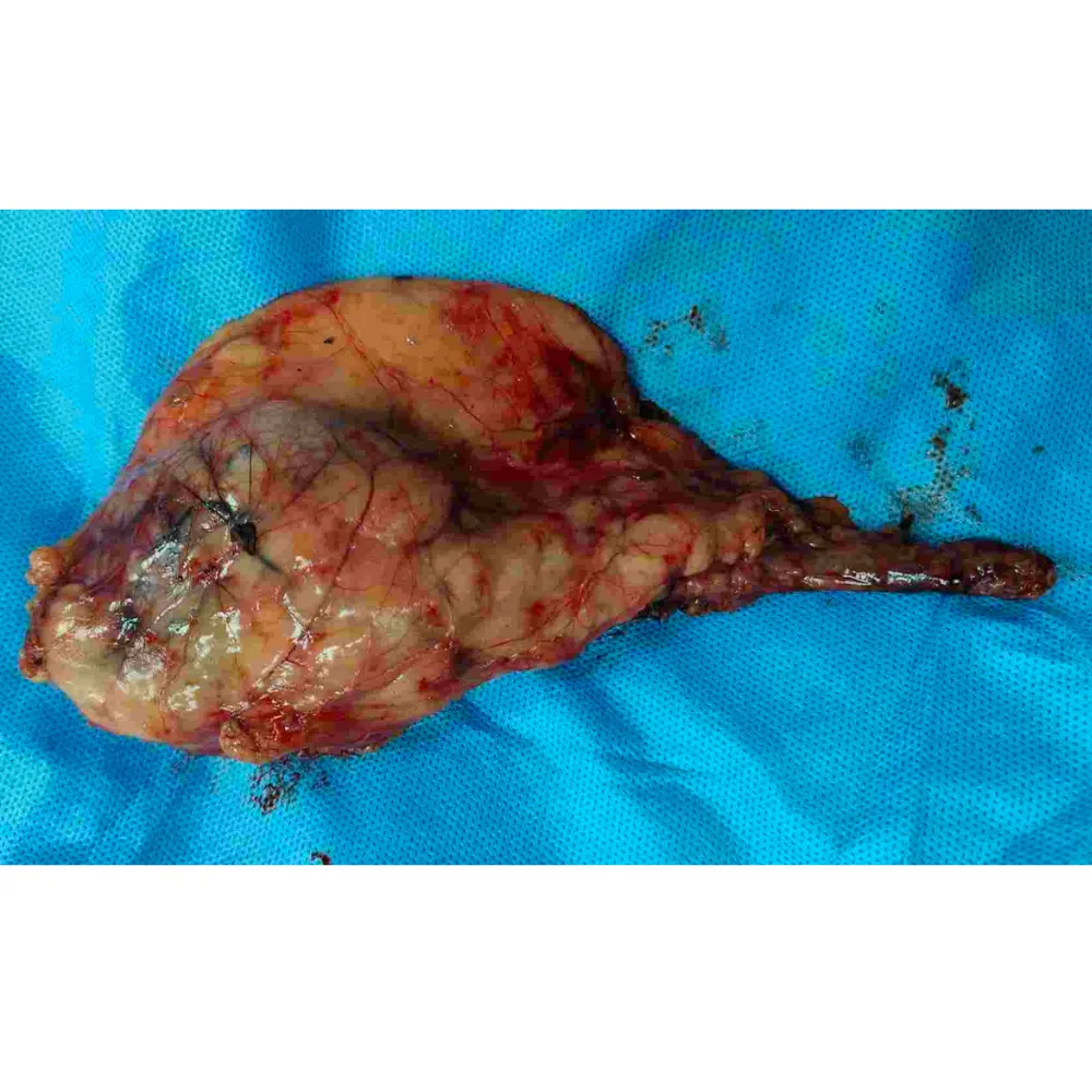 Robotic Right Nephrectomy and Lymph Node Dissection for Non Functional Kidney with Dense Adhesions 4