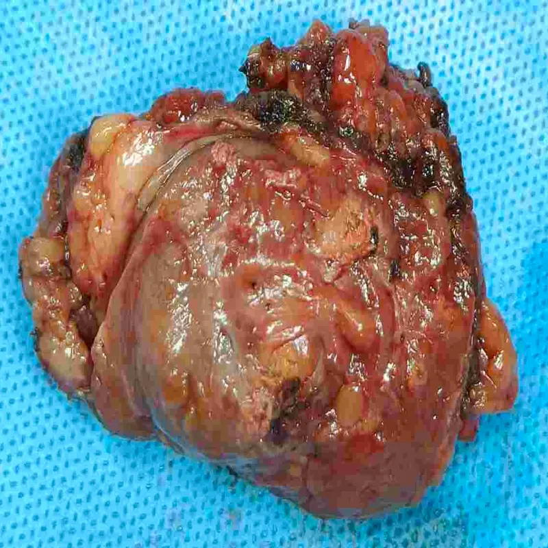 Robotic Right Partial Nephrectomy and Bilateral Inguinal Hernia Repair for Complex Renal Mass 4