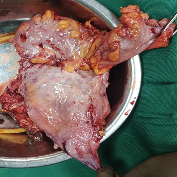 Robotic Total Pelvic Exenteration for Recurrent Cervical Cancer 1