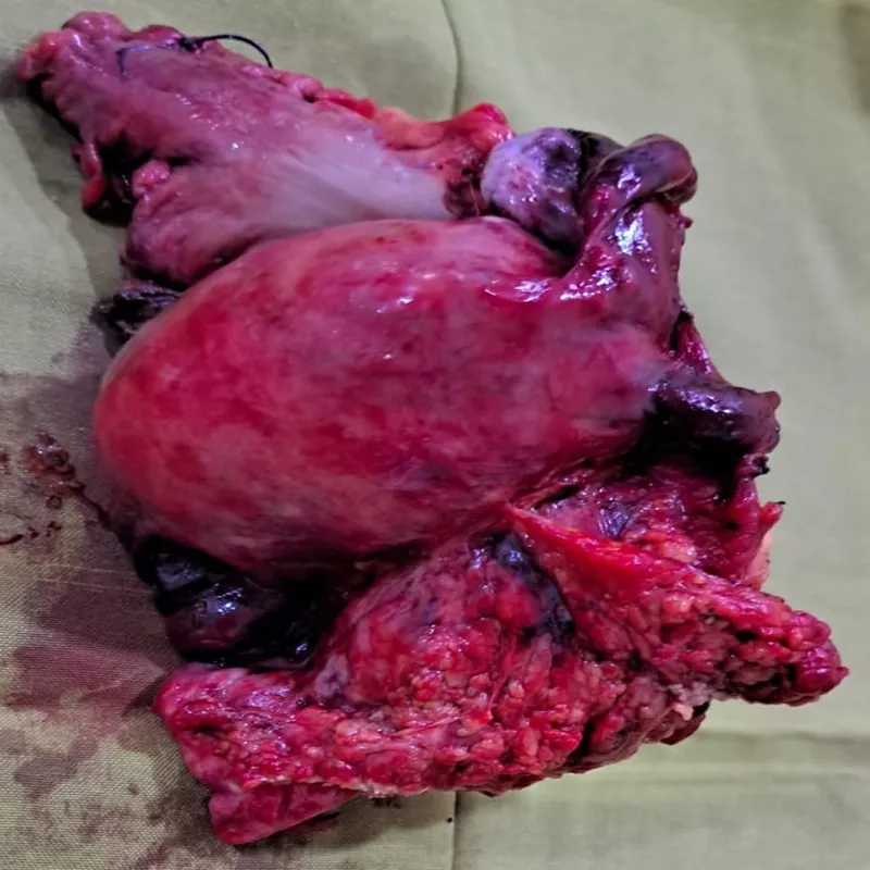 Total Pelvic Exenteration for Recurrent Cervical Cancer with Complex Bowel Reconstruction 1