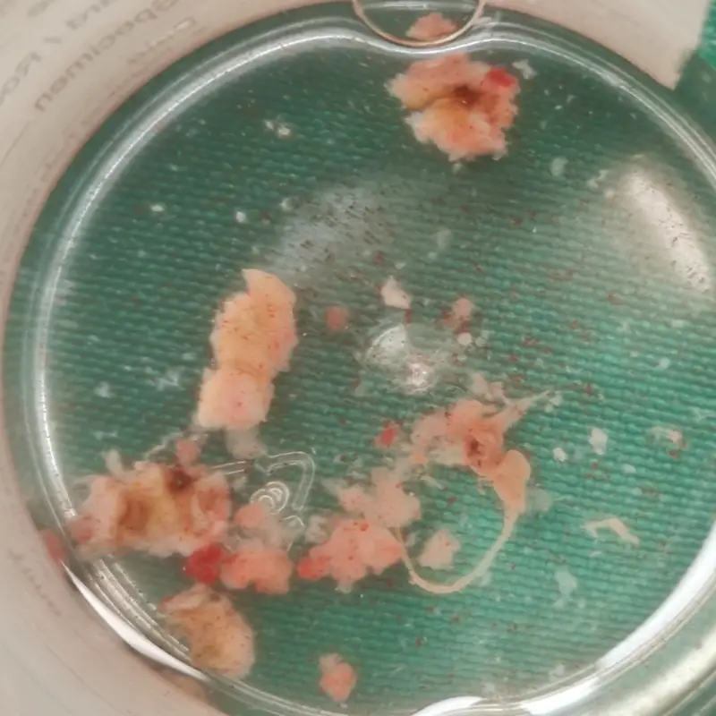 Transurethral Resection of Bladder Tumor for Early Stage Urothelial Carcinoma 1