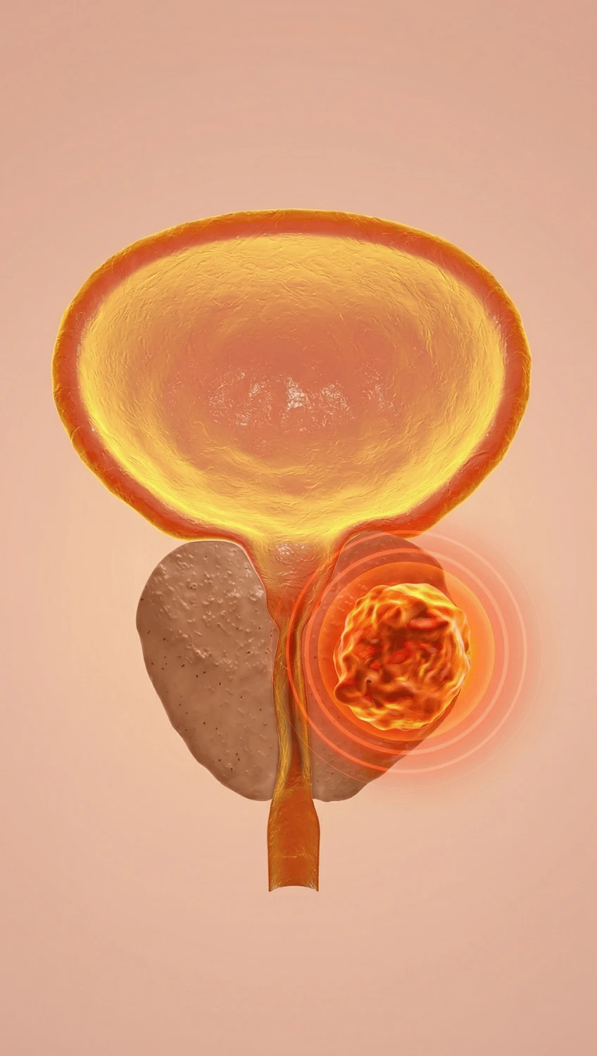 What is Prostate Cancer - Know the Diagnosis, Treatment, Surgery Options for it