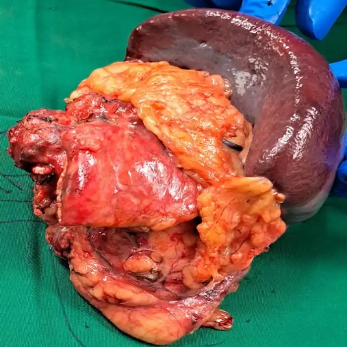 Advanced En Bloc Excision and Radical Nephrectomy for Recurrent Adrenocortical Carcinoma1 1