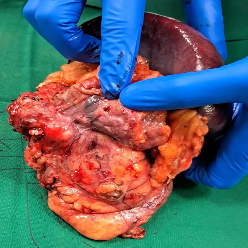 Advanced En Bloc Excision and Radical Nephrectomy for Recurrent Adrenocortical Carcinoma2 1