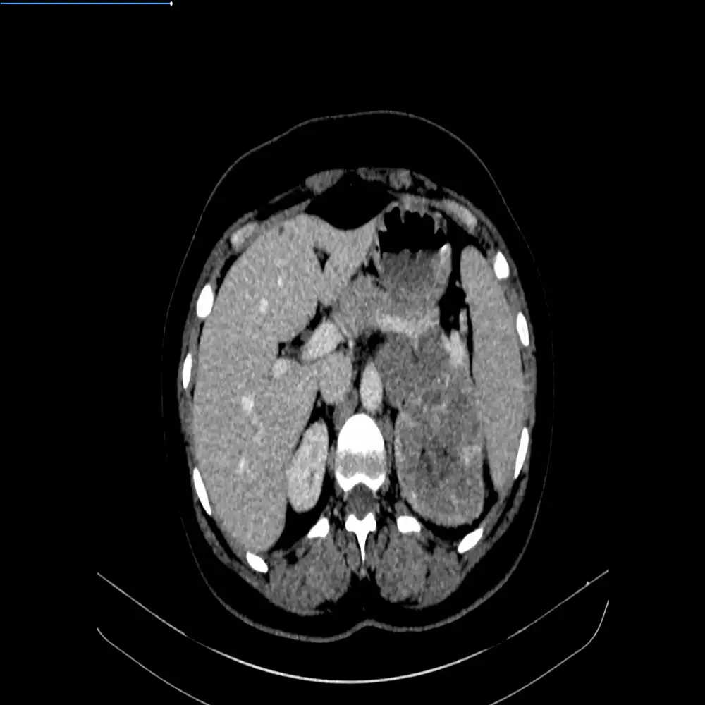 Advanced En Bloc Excision and Radical Nephrectomy for Recurrent Adrenocortical Carcinoma3 1