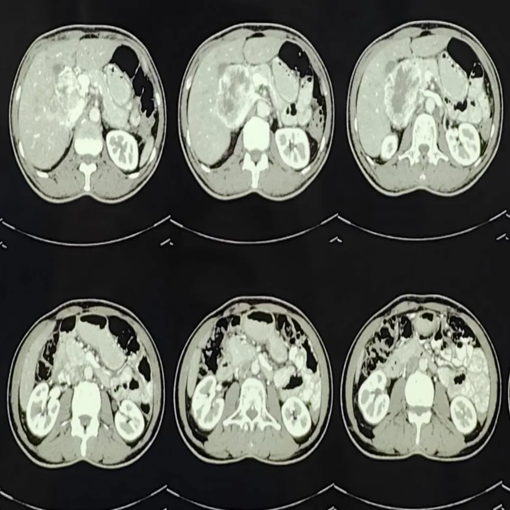 Advanced Retroperitoneal Mass Excision and Adrenalectomy for Complex Right Pheochromocytoma1 1