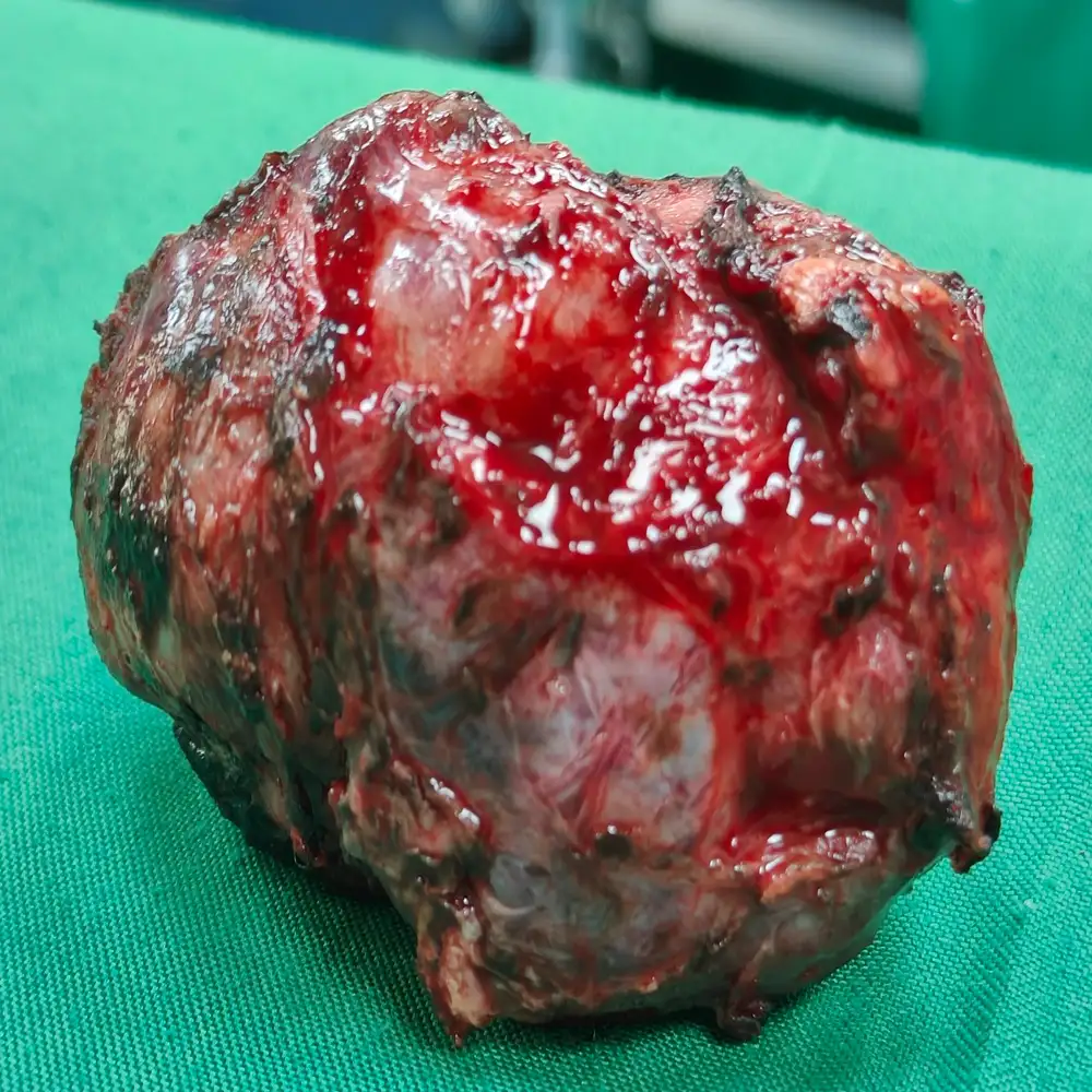Advanced Retroperitoneal Mass Excision and Adrenalectomy for Complex Right Pheochromocytoma2 1