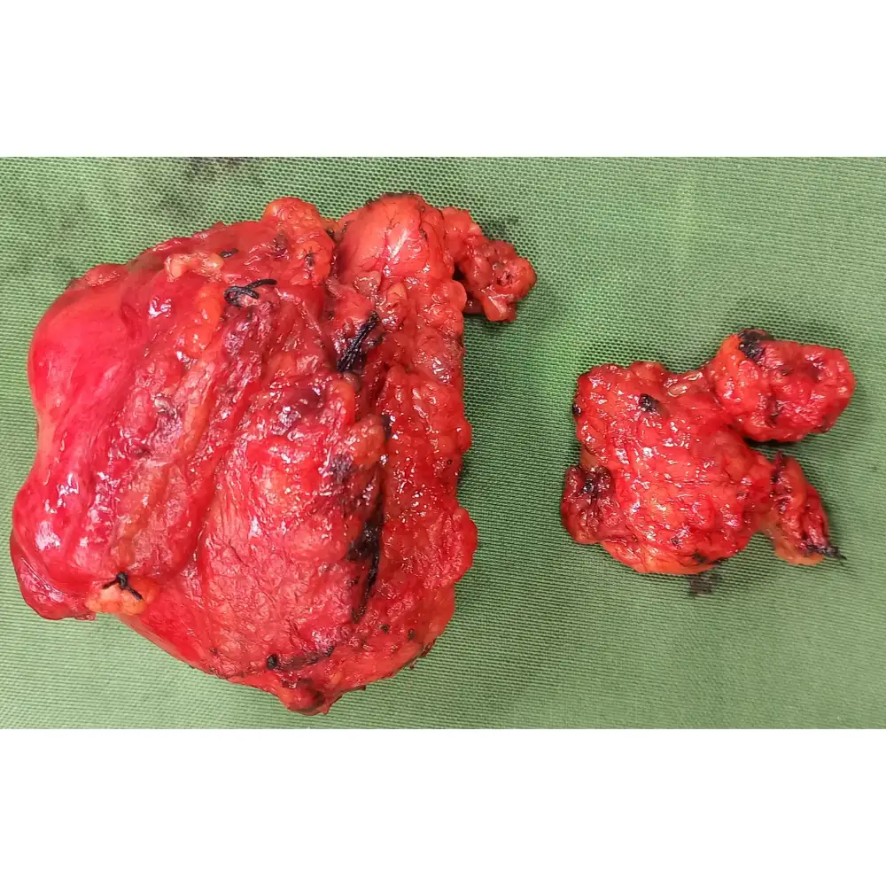 Advanced Retroperitoneal Mass Excision and Lymph Node Dissection for Complex Teratoma 1