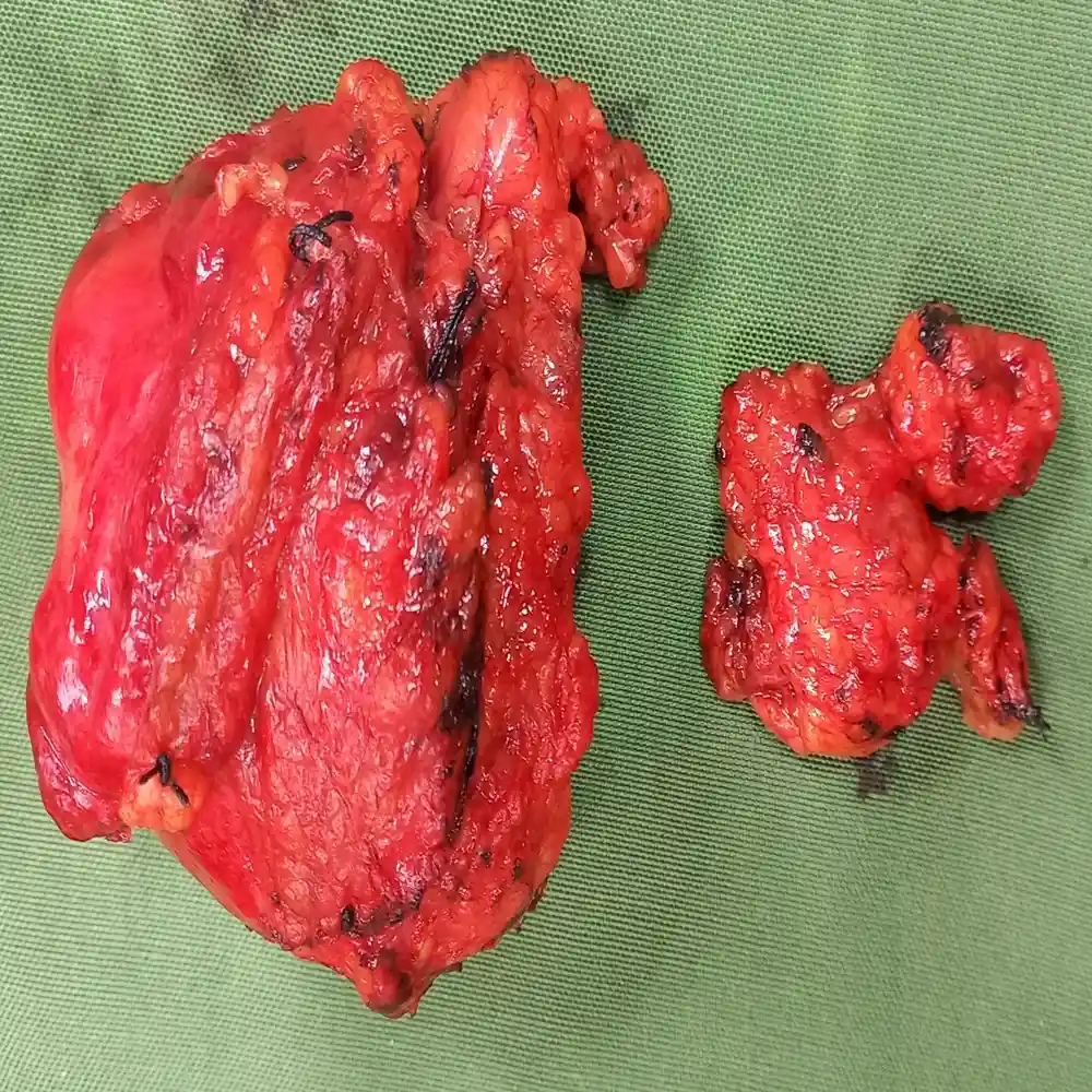 Advanced Robotic RPLND for Complex Retroperitoneal Teratoma Post Orchidectomy