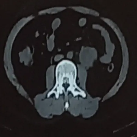 Advanced Robotic RPLND for Complex Retroperitoneal Teratoma Post Orchidectomy1