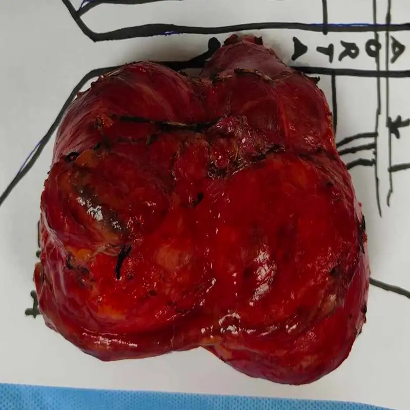 Advanced Robotic Retroperitoneal Lymph Node Dissection for Complex Mature Teratoma