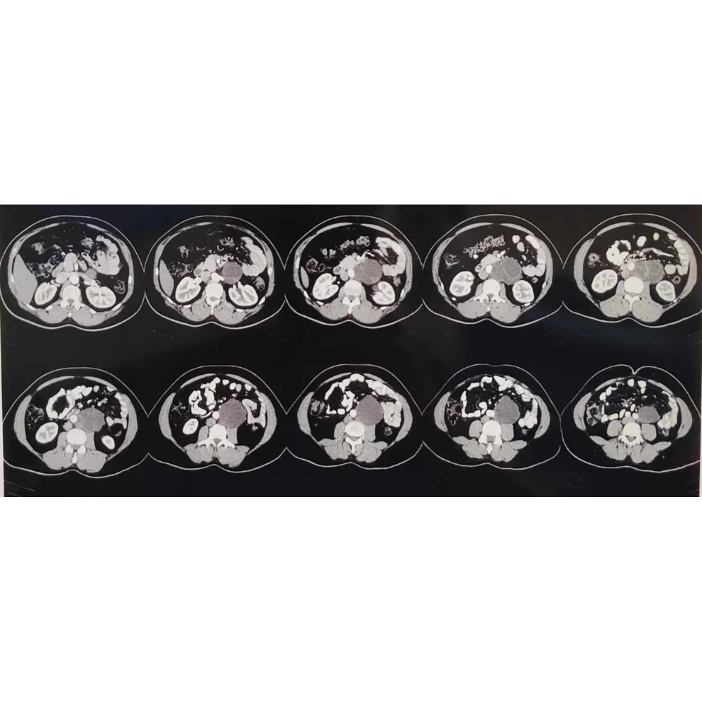 Advanced Robotic Retroperitoneal Lymph Node Dissection for Complex Mature Teratoma1