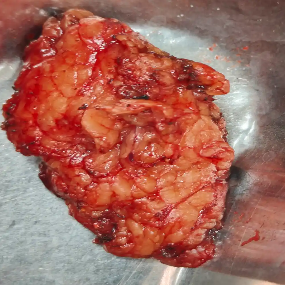 Advanced Robotic Right Adrenalectomy For Aldosterone Secreting Adrenal Adenoma 1