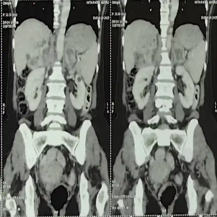 Complex Bilateral Adrenalectomy For Functioning Pheochromocytomas In A High Risk Patient1 1