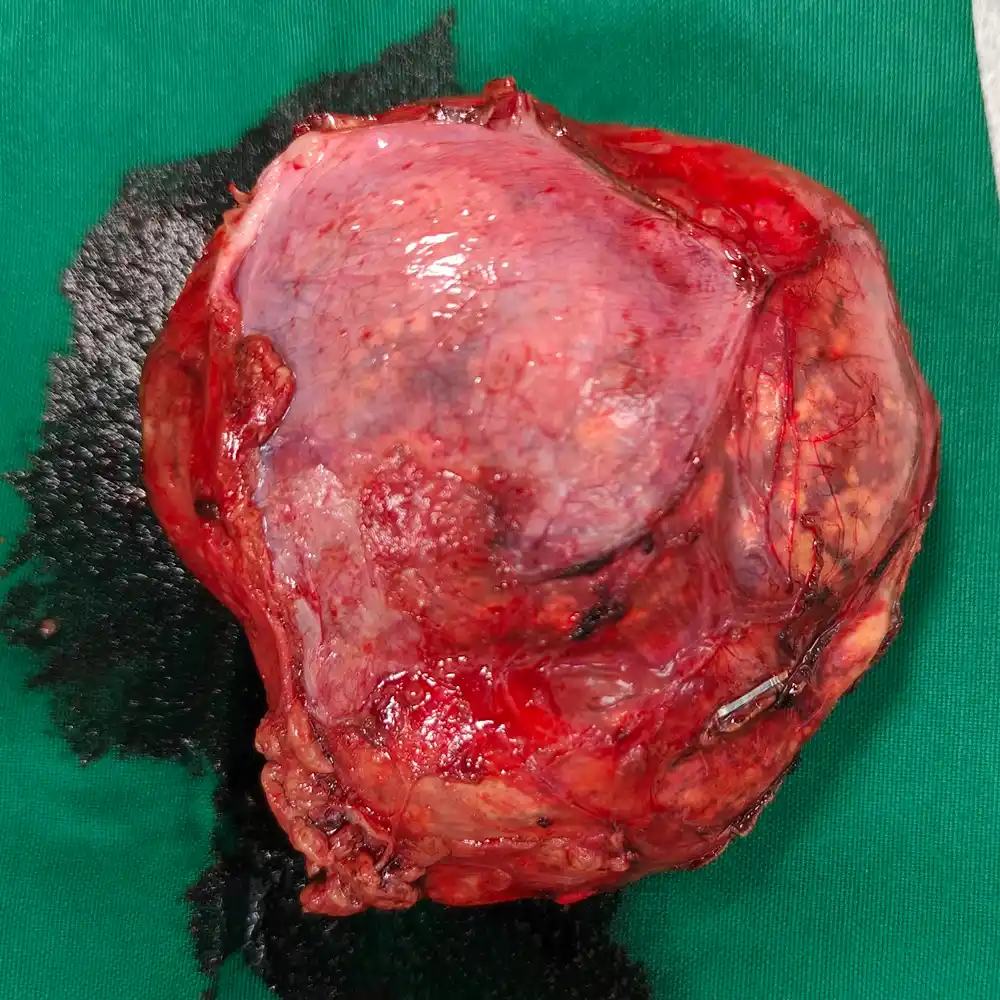 Complex Bilateral Adrenalectomy For Functioning Pheochromocytomas In A High Risk Patient2 1